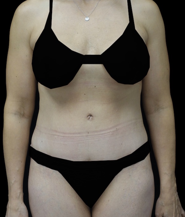 Tummy Tuck Before & After Patient #18378