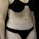 Tummy Tuck Before & After Patient #18378