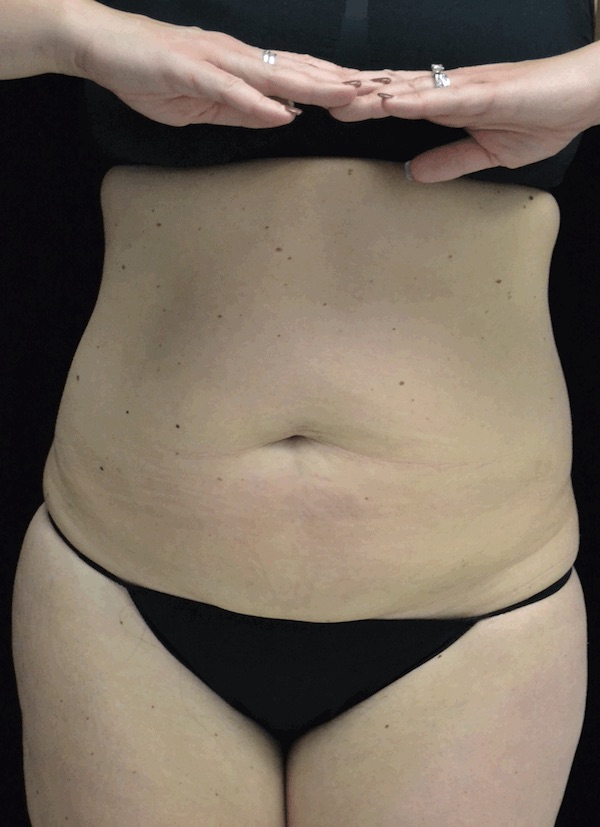 Tummy Tuck Before & After Patient #18371