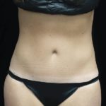 Tummy Tuck Before & After Patient #18371