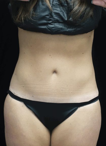 Tummy Tuck Before & After Patient #18371