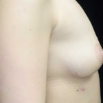 Asymmetric Tuberous Breasts Before & After Patient #18448