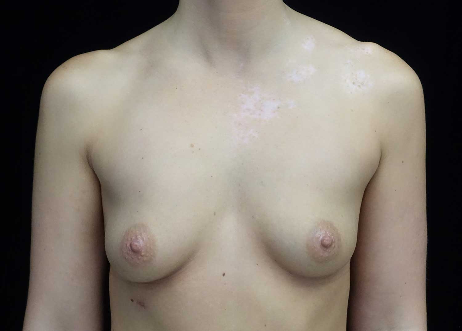 Asymmetric Tuberous Breasts Before & After Patient #18448