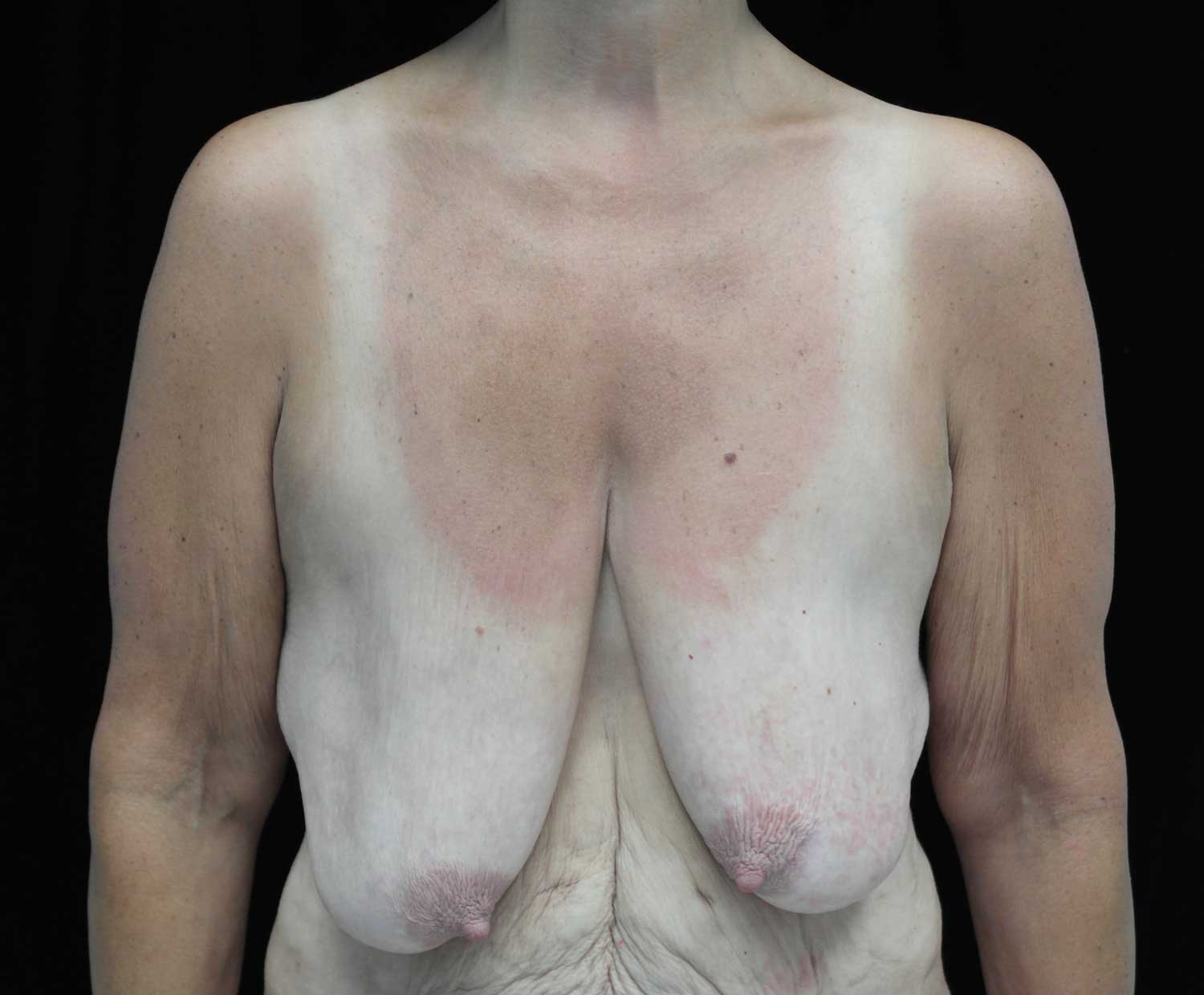Breast Lift Before & After Patient #18473
