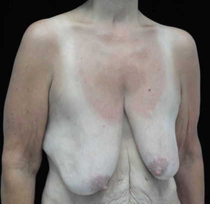 Breast Lift Before & After Patient #18473