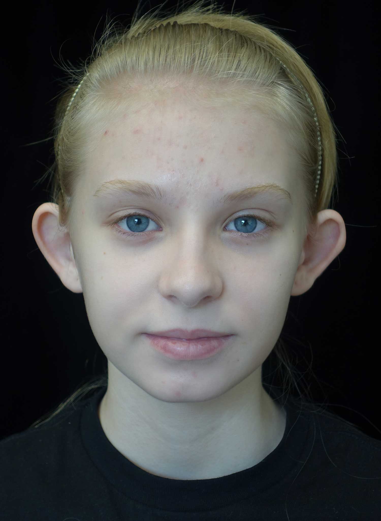 Otoplasty Before & After Patient #18481