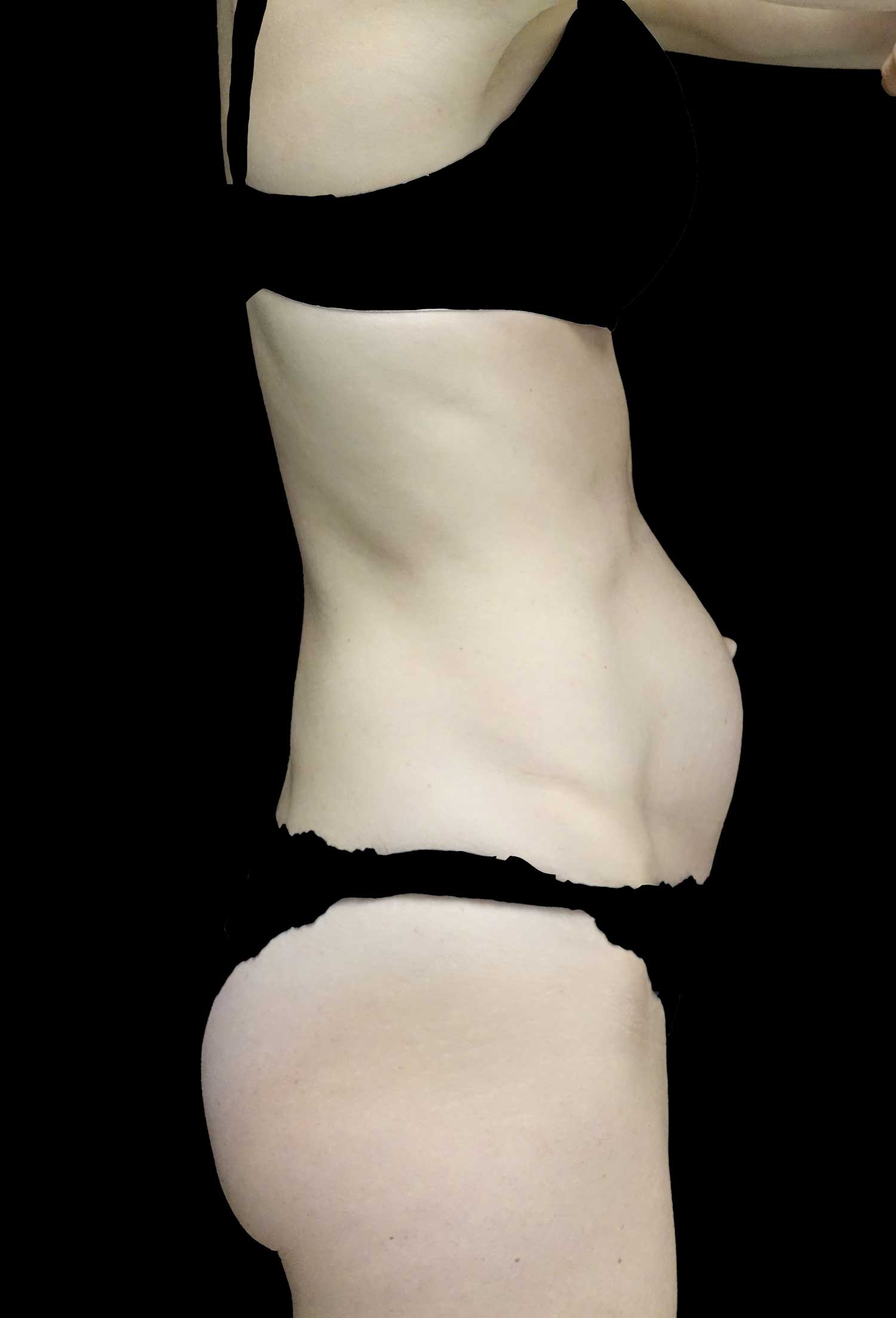Tummy Tuck Before & After Patient #18495