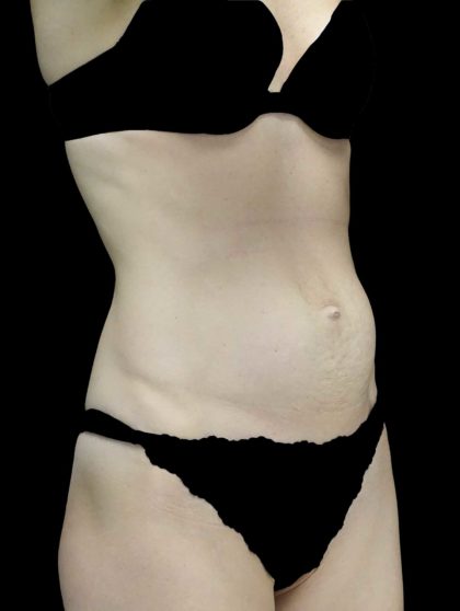 Tummy Tuck Before & After Patient #18495