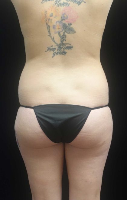 Liposuction Before & After Patient #18465