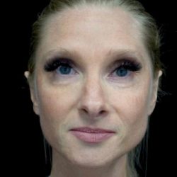 Otoplasty Before & After Patient #18484