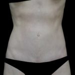 Tummy Tuck Before & After Patient #18495