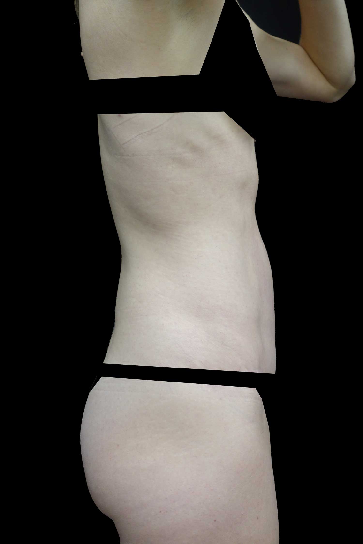 Tummy Tuck Before & After Patient #18495