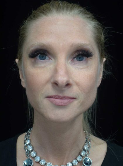 Otoplasty Before & After Patient #18484