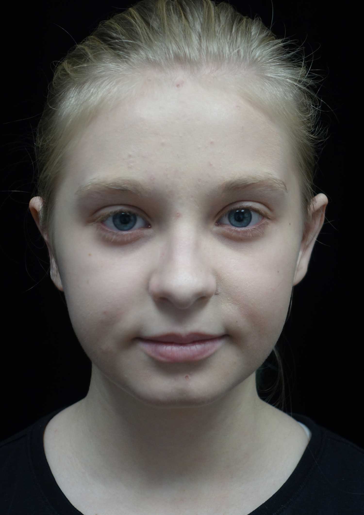 Otoplasty Before & After Patient #18481