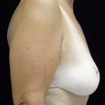 Breast Lift Before & After Patient #18473
