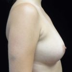 Breast Augmentation (Fat Transfer) Before & After Patient #18455