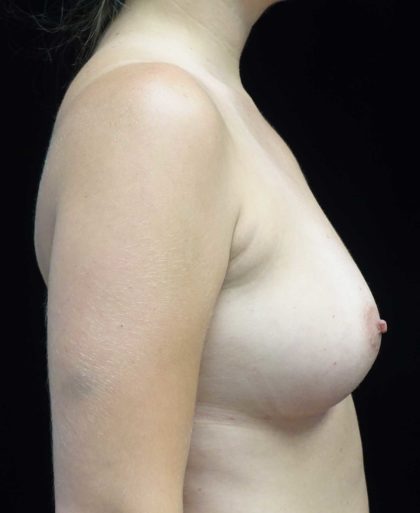 Breast Augmentation (Fat Transfer) Before & After Patient #18455