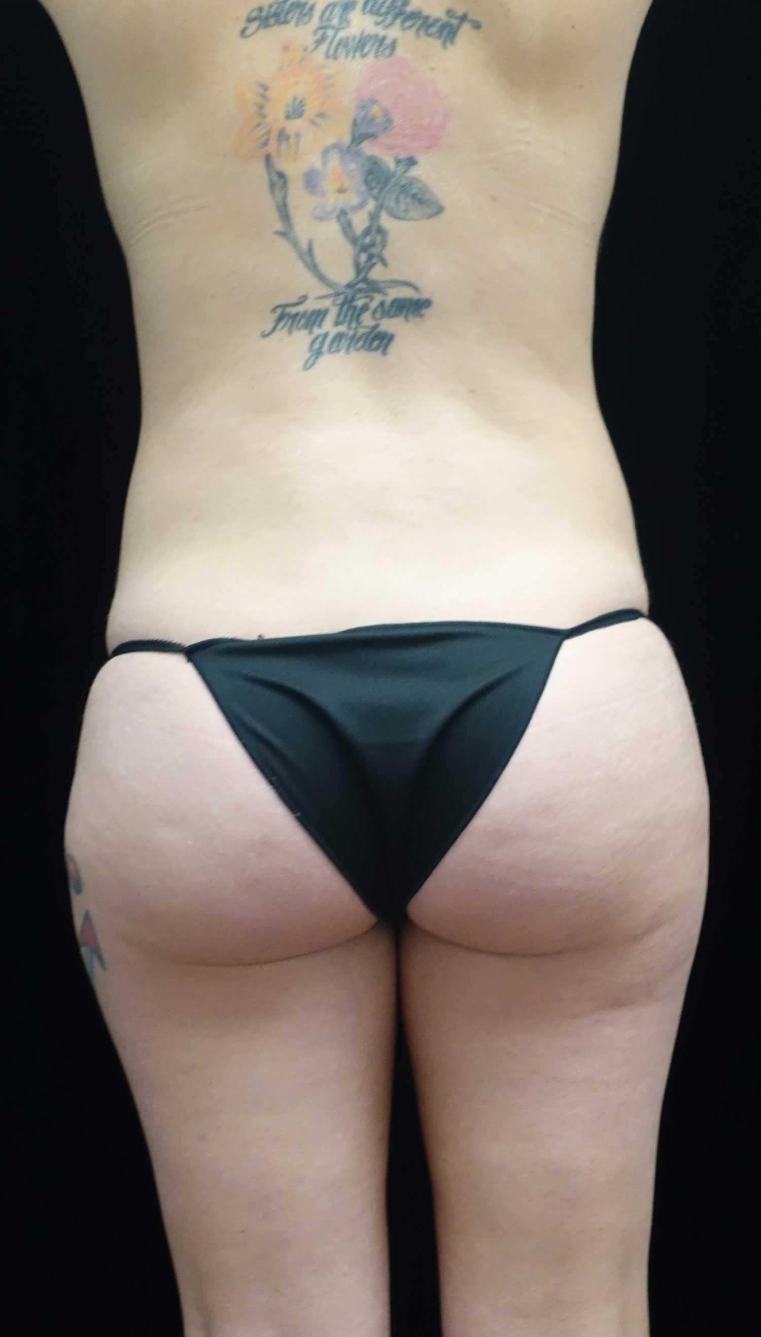 Liposuction Before & After Patient #18465
