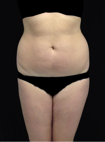 Liposuction Before & After Patient #18502