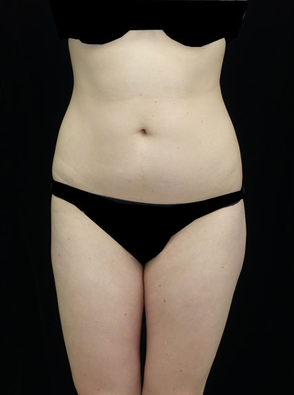 Liposuction Before & After Patient #18502