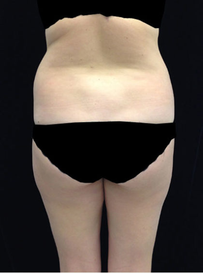 Liposuction Before & After Patient #18502