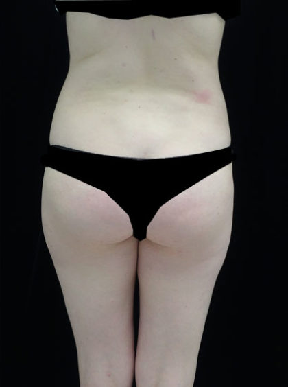 Liposuction Before & After Patient #18502