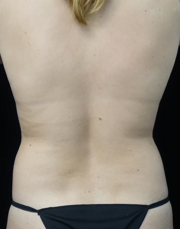 CoolSculpting Before & After Patient #18509