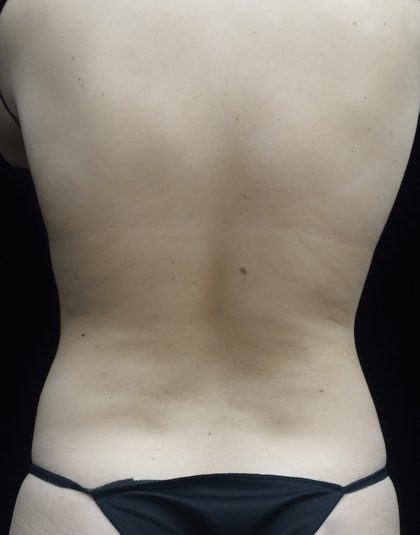 CoolSculpting Before & After Patient #18509