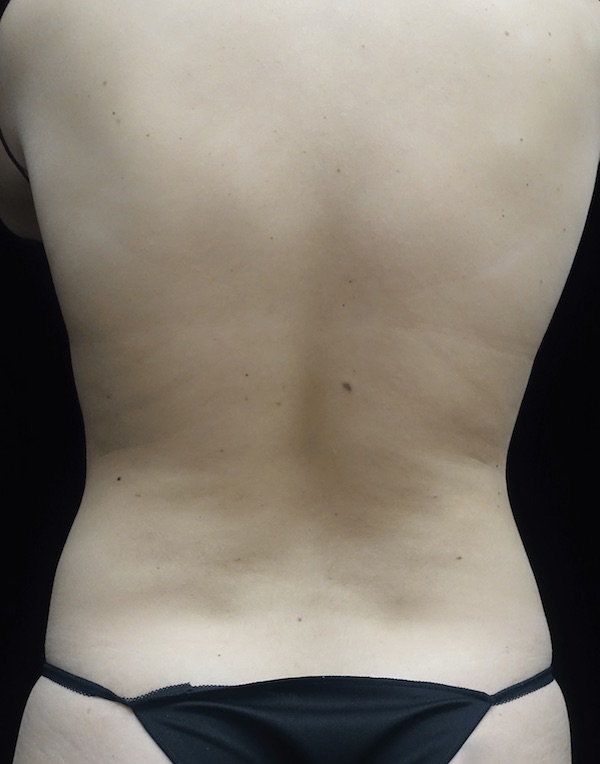 CoolSculpting Before & After Patient #18509