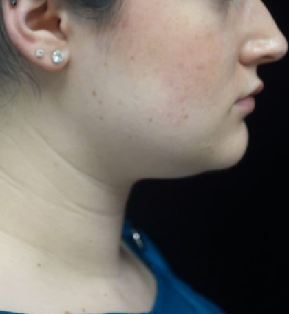 Kybella Before & After Patient #18512