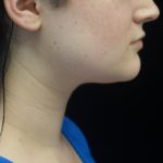 Kybella Before & After Patient #18512