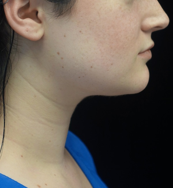 Kybella Before & After Patient #18512
