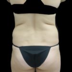 Liposuction Before & After Patient #18524