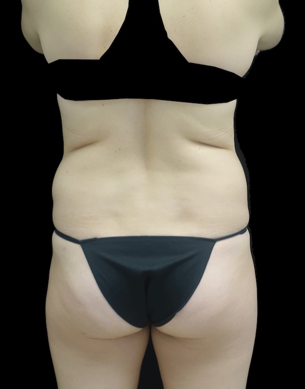 Liposuction Before & After Patient #18524