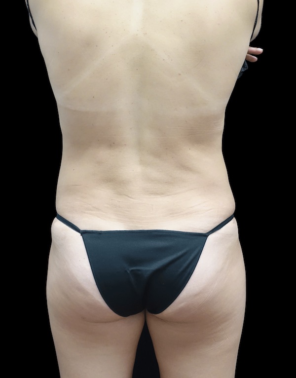 Liposuction Before & After Patient #18524