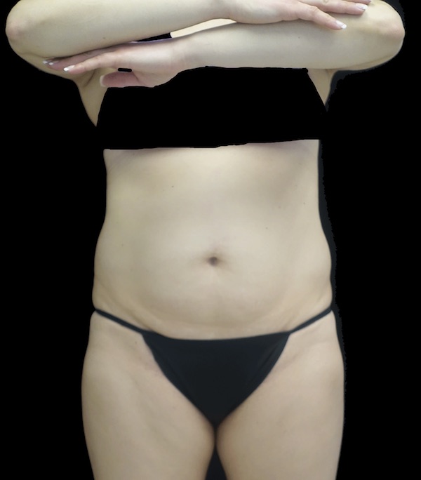 Lipoabdominoplasty Before & After Patient #18527