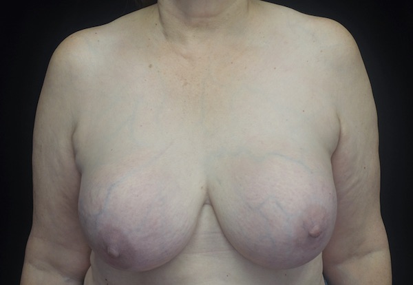 Breast Lift Before & After Patient #18534