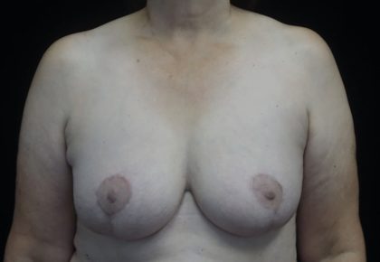 Breast Lift Before & After Patient #18534