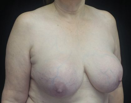 Breast Implant Removal (Explant Surgery) Before & After Patient #18534