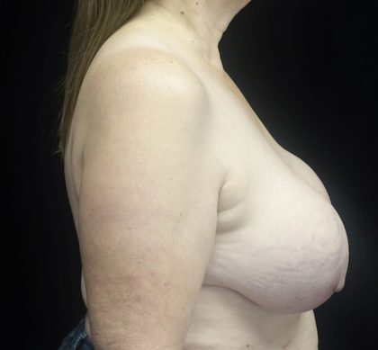 Breast Lift Before & After Patient #18534
