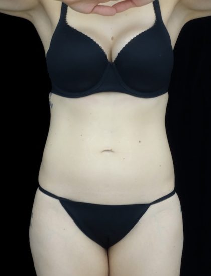 Tummy Tuck Before & After Patient #18541