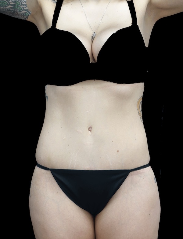 Tummy Tuck Before & After Patient #18541