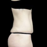 Tummy Tuck Before & After Patient #18541