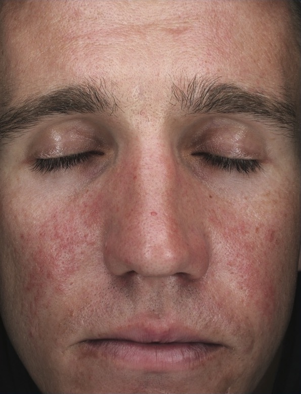 Chemical Peels Before & After Patient #18662
