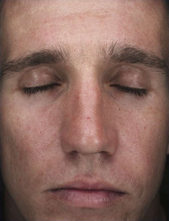 Chemical Peels Before & After Patient #18662