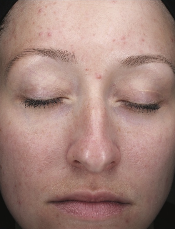 Chemical Peels Before & After Patient #18665