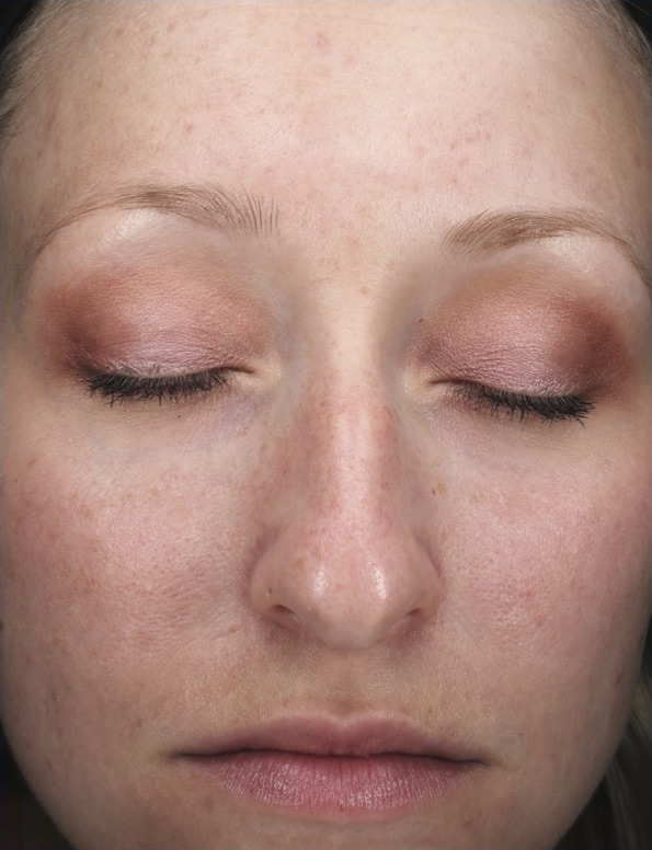 Chemical Peels Before & After Patient #18665