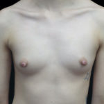 Breast Augmentation (Implants) Before & After Patient #18674