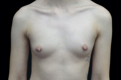 Breast Augmentation (Implants) Before & After Patient #18674