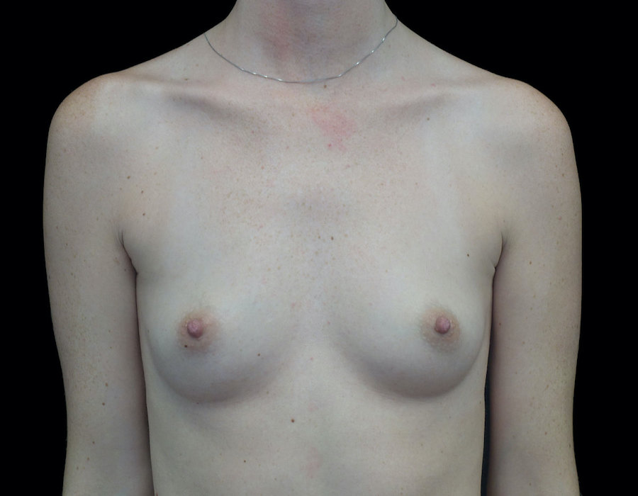 Breast Augmentation (Implants) Before & After Patient #18681